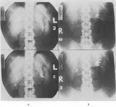 Image result for Intravenous Pyelogram