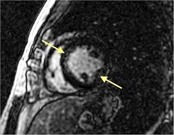 Was heute alles möglich ist. Cardiac Mri Confirmed Mesalamine Induced Myocarditis Bmj Case Reports
