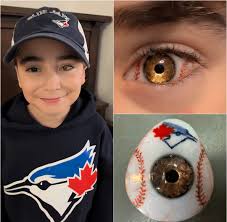 🚨 **Logan's Special Eye Prosthetic** 👁️💖 8-year-old **Logan Dorna** from  Canada, who lost an eye to cancer, received a **custom prosthetic**  featuring his favorite baseball team: the **Toronto Blue Jays** ⚾🇨🇦.  Created