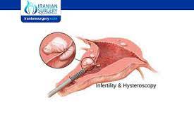 Diagnostic Hysteroscopy Infertility Can I Get Pregnant After Hysteroscopy