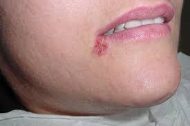 Angular Cheilitis Main Causes And Treatment Tua Saude