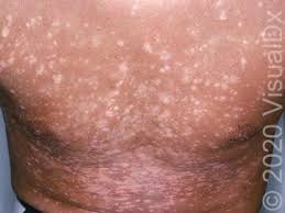 Image result for Postinflammatory Hypopigmentation