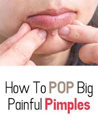 How To Pop Big Painful Pimples Painful Pimple Pimples Skin Ulcer