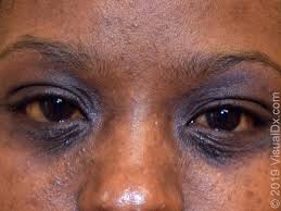 Atopic dermatitis lasts a long time. Eyelid Dermatitis Eczema Uptodate