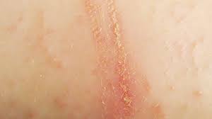 Image result for sore skin in the groin area