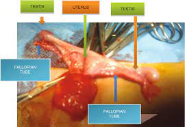 Persistent Mullerian Duct Syndrome Hernia Uteri Inguinalis Springerlink