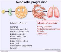 Several treatments can slow its. Defining The Hallmarks Of Metastasis Cancer Research