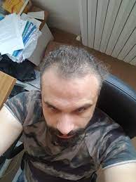 Sac Icin Prp Tedavisi Hakkinda Yaptirdim