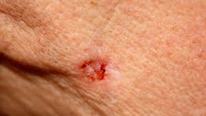 Image result for Skin Ulcer