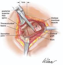 The anterior superior iliac spine is a bony projection of the iliac bone, and an important landmark of surface anatomy. 54 Posterior Iliac Crest Bone Graft Pocket Dentistry