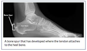 You may have achilles tendonitis. Achilles Tendinitis Bouldercentre For Orthopedics Spine