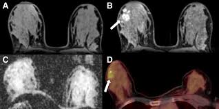 Tumors are likely to be smaller when doctors detect them early, which can. Multiparametric 18f Fdg Pet Mri Of The Breast Are There Differences In Imaging Biomarkers Of Contralateral Healthy Tissue Between Patients With And Without Breast Cancer Journal Of Nuclear Medicine