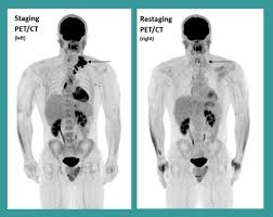 Image result for Lymphoma