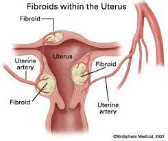 0:13 a) uterine fibroids are also known as myomas or leiomyomas. Uterine Fibroids Office On Women S Health
