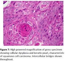 A keratin pearl is a keratinized structure found in regions where abnormal squamous cells form concentric layers. ØªÙˆÙŠØªØ± Dermz Ø¹Ù„Ù‰ ØªÙˆÙŠØªØ± Squamous Cell Carcinoma Scc 2nd Most Common Skin Cancer Associated With Excessive Sun Exposure Immunosuppression Amp Draining Sinus Commonly On Lower Lip Amp Ears
