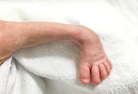 My daughter has been diagnosed with a right clubfoot. Club Foot In Infants Reasons Signs Remedies