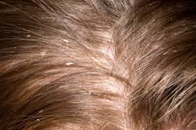 Nhs 111 Wales Encyclopaedia Dandruff Adults