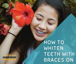 Method of how to whiten teeth fast, with or without baking soda, at home naturally, with hydrogen peroxide, turmeric and the braces. How To Whiten Teeth With Braces On