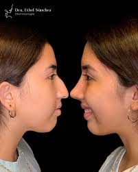 ✨ Recuerda que invertir en ti siempre será la mejor decisión ✨ La  rinoplastia no solo transforma tu perfil, también mejora tu respiración y  tu calidad de vida. 👩🏻‍⚕️ Dra. Ethel Sánchez -