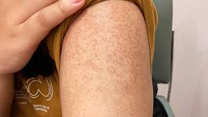 Image result for Keratosis pilaris