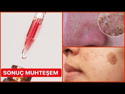 Sadece 3 Damla Bile Yeter Uyumadan Once Sur Sonra Yat Bebek Gibi Yumusacik Cilt Youtube Derma Roller Deodorant Youtube