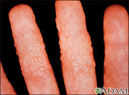 Ringworm Of The Body Vancouver Sun The rings usually start small and then ringworm of the body (tinea corporis) is a rash caused by a fungal infection. vancouver sun