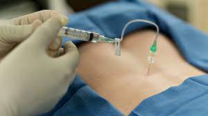 What Is An Epidural Benefits And Side Effects Mommabe
