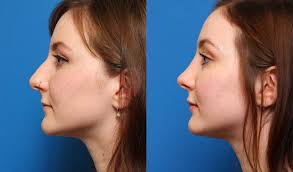 Colloquially known as a nose job, rhinoplasty is a plastic surgery procedure to sculpt the shape of the nose externally for cosmetics, and internally for breathing. Rhinoplasty Steps Nose Job Cost In Iran 1290 Best Clinics And Surgeons