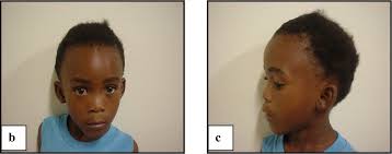 Figure 1 2 From Genetic Susceptibility To Fetal Alcohol Syndrome In The Northern Cape Coloured Population Potential Roles Of Astrotactin And Reelin Semantic Scholar