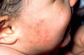 But the itching can be so intense or recurrent that it disrupts your sleep, sexual function and quality of life. Neurodermitis Ratselhafte Krankheit Pz Pharmazeutische Zeitung