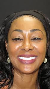 Denitra's smile makeover journey was a great experience from start to  finish! 😁✨ She is thrilled with the results and she is now beaming with  confidence!