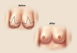 Generally, medicare needs to consider your procedure medically necessary for it to be covered. Breast Reduction My Insurance Will Pay For That Dr Michaels Blog
