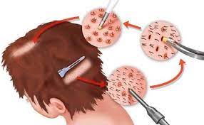 How to revive dead hair follicles. Discover How To Revive Dead Hair Follicles Naturally Hair Growing Genius Rimedi Contro La Caduta Dei Capelli Perdita Dei Capelli Capelli