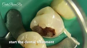 Perawatan saluran akar gigi biasanya ditunjukan untuk gigi dengan bentuk yang masih baik dan masih bisa dipertahankan tanpa perlu dilakukan pencabutan gigi. My Endodontic Jorney Perawatan Saluran Akar Gigi Premolar 34 Youtube