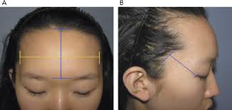 The same feature on men is properly called a widower's. Figure 2 From Classification Of The Female Hairline And Refined Hairline Correction Techniques For Asian Women Semantic Scholar