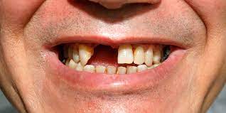 Maybe you would like to learn more about one of these? Penjelasan Jenis Gigi Palsu Permanen Dan Lepasan