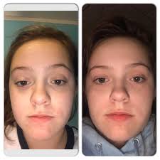 Clear skin for teens with baby moisturizer