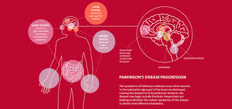 To find out how far the disease has progressed, many doctors use a rating scale called the hoehn and yahr staging of parkinson's disease: Progress Against Parkinson S Disease Uci Health Orange County Ca