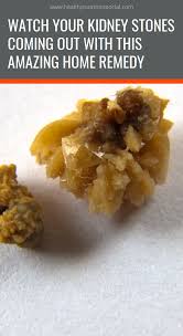 Watch Your Kidney Stones Coming Out With This Amazing Home Remedy Natural Healing Remedies Natural Remedies Remedies