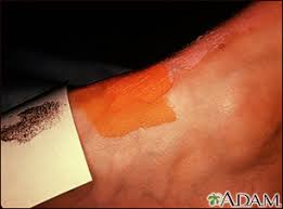 Image result for Sweat Chloride