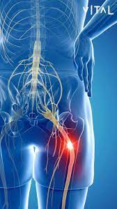 Tienes dolores asociados al nervio ciático? No dudes en consultarnos  escribiéndonos un mensaje o comentando esta publicación. En Vital contamos  con la mejor infraestructura, el mobiliario clínico más completo y  equipamientos de