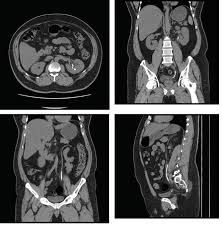 Ct scans are widely used in emergency rooms because the procedure takes less than 5 minutes. Non Contrast Ct In The Evaluation Of Urinary Tract Stone Obstruction And Haematuria Intechopen