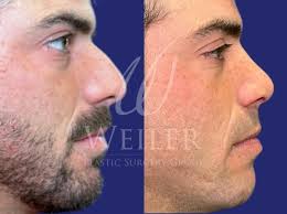 Rhinoplasty Before and After Pictures Case 1491