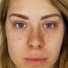 Who Loves These Brows Freckles Transformations As Much As Me All The Way From Toronto Tattooed Br Tattooed Freckles Freckles Beautiful Freckles