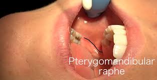 Image result for Periapical Block