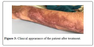 Image result for Erysipeloid