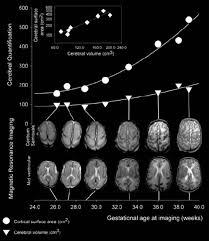 Image result for Preterm Infant Growth
