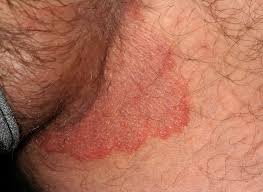 Image result for scabies on genitals