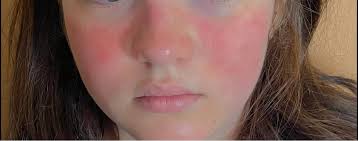 Melissas Leben mit frühkindlichem systemischen Lupus und NMOSD