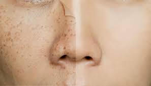 Image result for Freckled skin